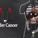 Bladder Cancer (Ca of bladder)