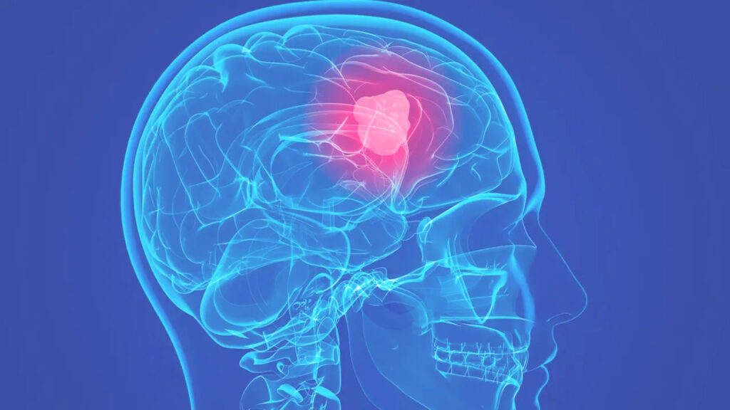 Gliomas: Symptoms, Causes, and Treatment - MDMEDICINE