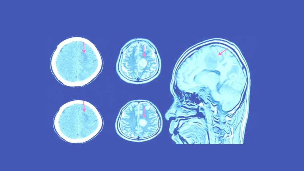 Subdural Hematoma Causes Symptoms Diagnosis Treatment And