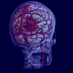 Hemorrhagic Strokes: Causes, Symptoms, and Prevention – You need to know
